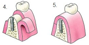 implantaten kosten